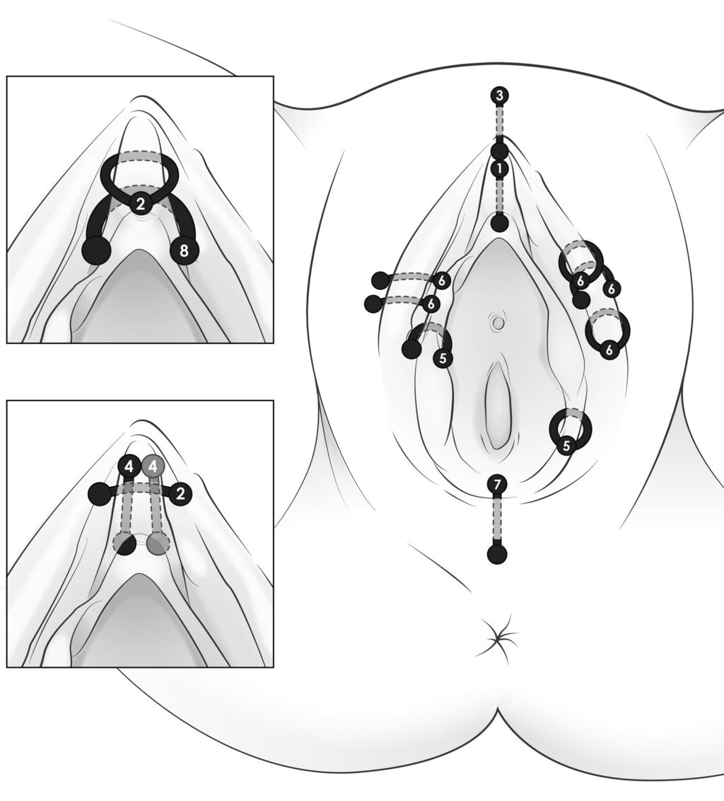Section 6a: Female genital piercings 1. Vertical clitoral hood 2. Horizontal clitoral hood (ring, teardrop ring, curved barbell) 3.