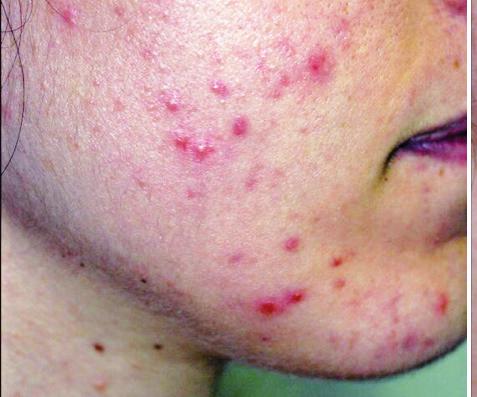 7 CLINICAL ASSESSMENT - FACE 10 ACNE SEVERITY (LEEDS REVISED GRADE) 50 48 COMEDONIC LESIONS 8 6 4 2 4 6 4 2 40 30 20 10 27 31 14 PLACEBO PLACEBO t 0 t 12 weeks t 0 t 12 weeks (Graph 5) THE SEVERITY