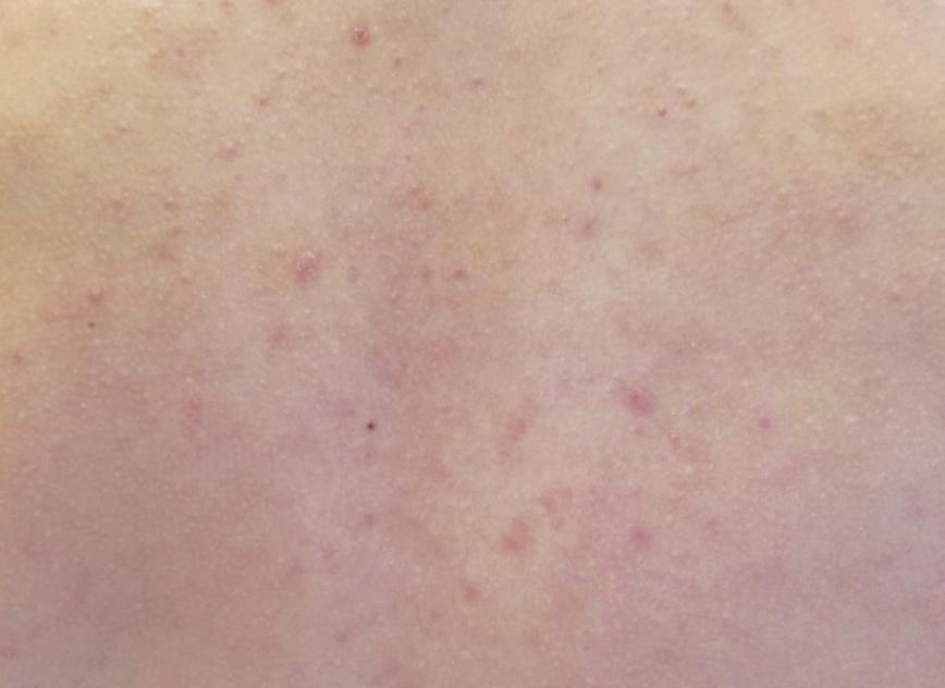 aged from 13 to 20 years, affected by light to moderate acne on the back and/or chest.