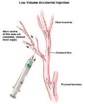 Slide 22 Even Low Volume Accidental Injection Can Lead to Arterial Occlusion if Injected Intraarterially DeLorenzi C.