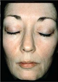 Clinically proven compatible with and enhances the benefits of cosmetic procedures such as microdermabrasion, peels