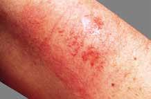 Open lesions may be accompanied by erythema and blister formation.