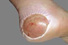 Appears as small inflamed elevations of skin surrounding the hair follicle. May be nonsuppurative (papules) or contain pus (pustules).