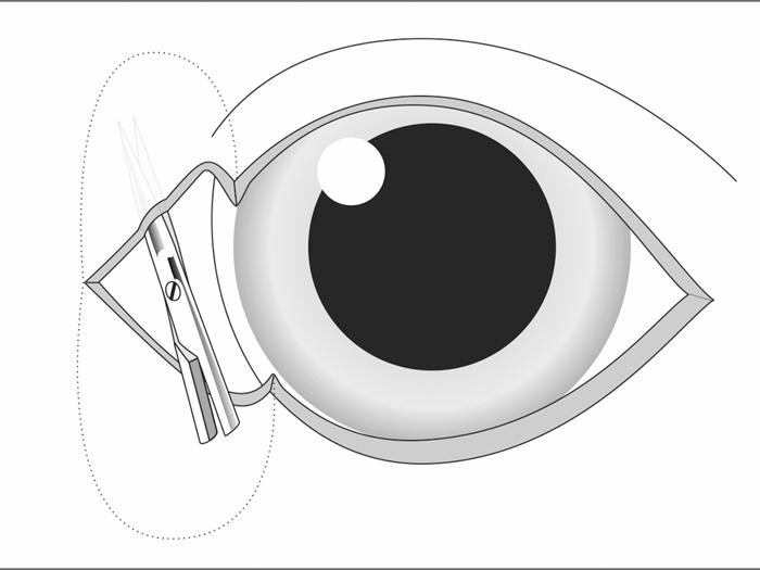 Figure 11. Pocket technique medial canthoplasty. A, The medial canthus skin that has been removed is shown, as well as the subcutaneous pocket formation using tenotomy scissors.