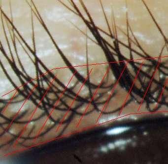 Evaluation of the lash density Lash density : number of roots per unit of surface 1 - At D0, 4 weeks and 8 weeks, photographs of the upper lashes were taken with a camera fixed