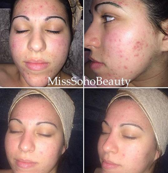We started slow and drip fed the skin and in under three months this is the result achieved! - Miss Soho Beauty 10-May-2016 4 The Confidence Files.