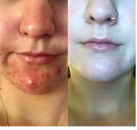 These results were achieved combining Gentle Antioxidant Cleanser, Exfoliating Cleanser, B3 Plus, Potent Clearing Serum, Retinol Concentrate, Recovery Cream and Mineral Pro SPF 30+ at home and