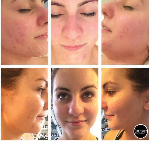 6 Repost Farrago Skin and Body: OMG! Amazing results from ONE O Cosmedics power peel.