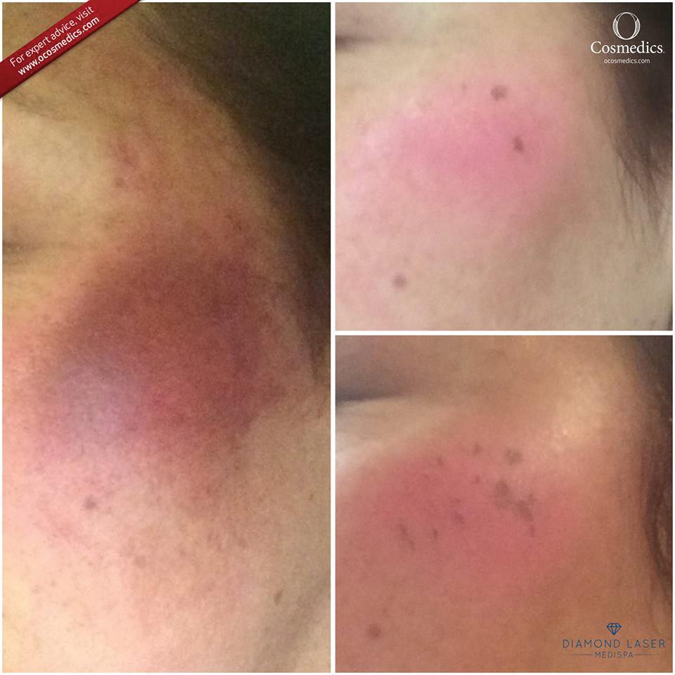 12 There is nothing more important to skin health than an Expert and this fantastic transformation from Diamond Medi Spa shows why. Anything is possible with the right advice and your commitment!