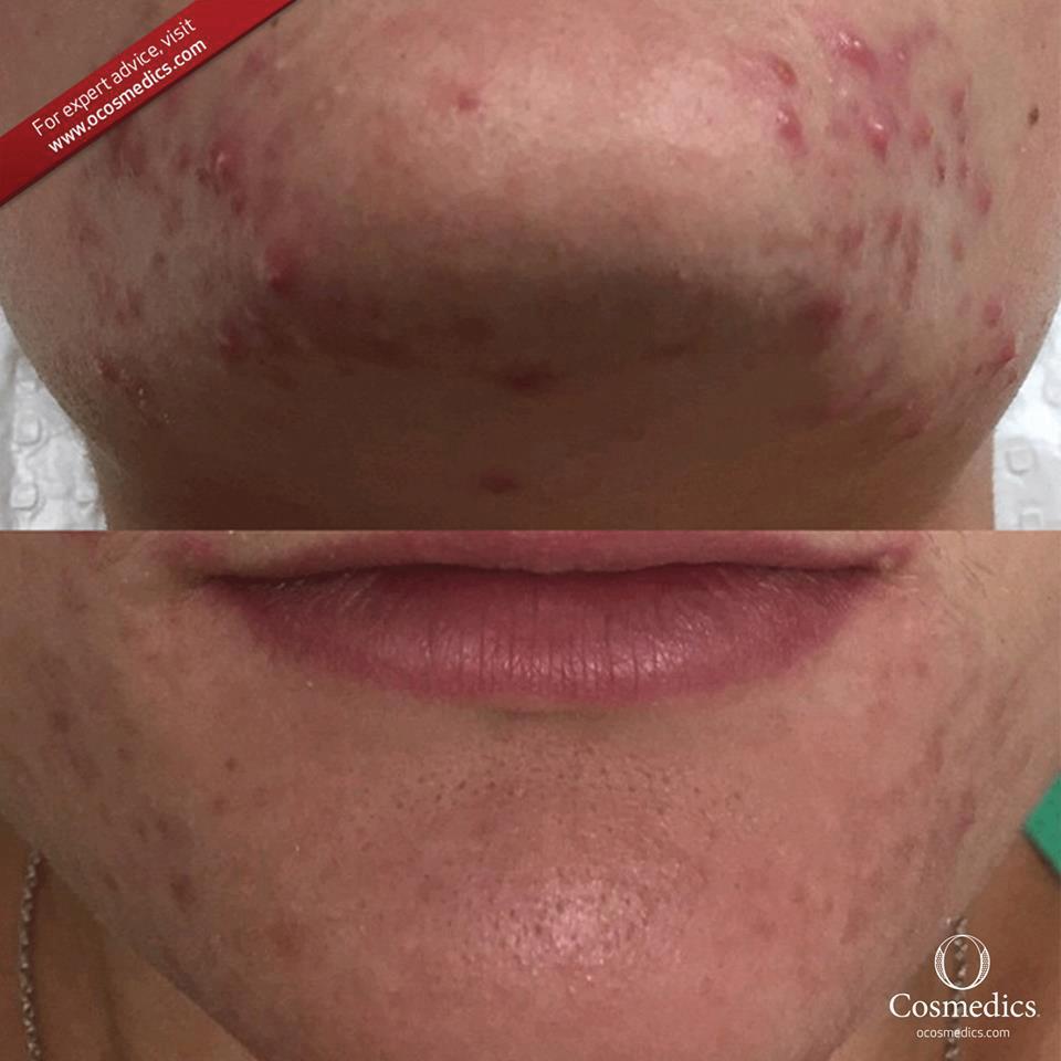 15 How great are these results achieved in only five weeks with the guidance of the O Skin Experts at Le Chic Skin & Beauty!