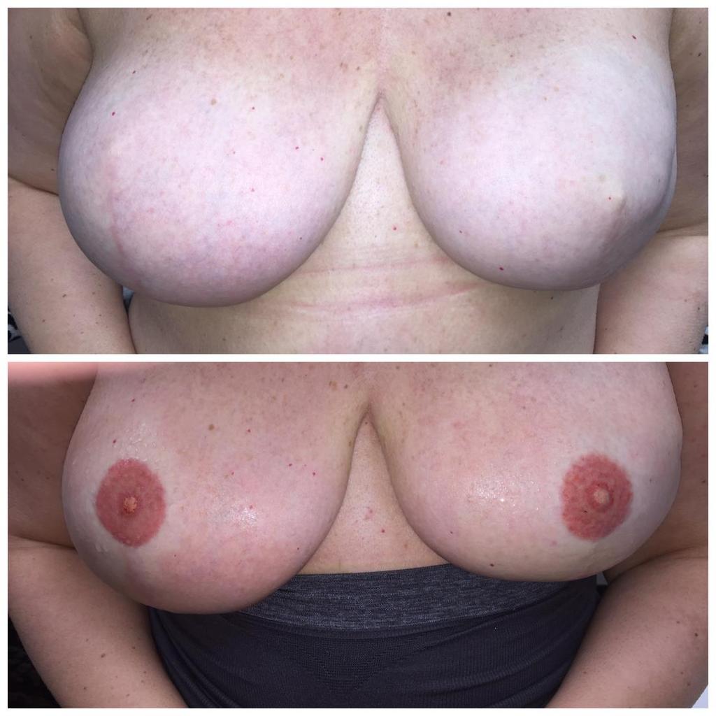 When one breast is fuller than the other, the placement and size