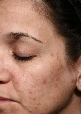 Signs of Skin Aging Lines &