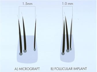 These groups are the clinical correlate of the follicular unit. A) Slightly low donor hair density at 2.0/hairs per follicular unit. B) High donor hair density at 3.2/hairs per follicular unit.