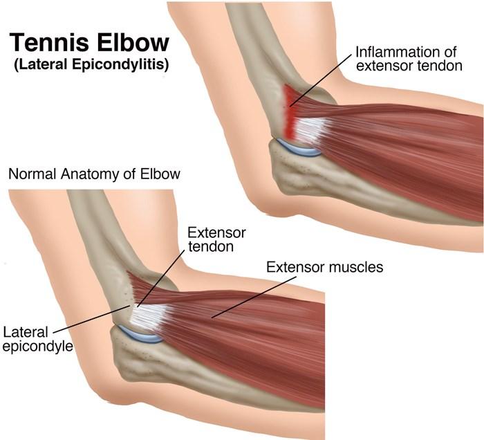 Injury clinic Tennis elbow (lateral epicondylitis) Who is affected by tennis elbow? It is estimated that as many as one in three people have tennis elbow at any given time.