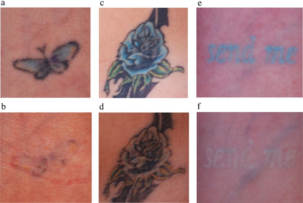A NOVEL TITANIUM SAPPHIRE PICOSECOND LASER 707 Fig. 1. Cross-polarized, digital images taken before (a,c,e) laser treatment and after (b,d,f) the 4th treatment.