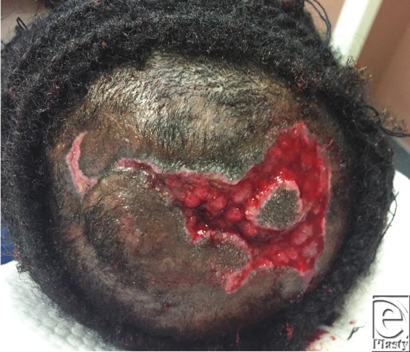 Interesting Case Series Hair Braiding-Induced Scalp Necrosis: A Case Report Zachary Borab, MD, a Madeleine Gantz, MD, a Michael Mirmanesh, MD b and Hengli Lin, MD c a Drexel University College of