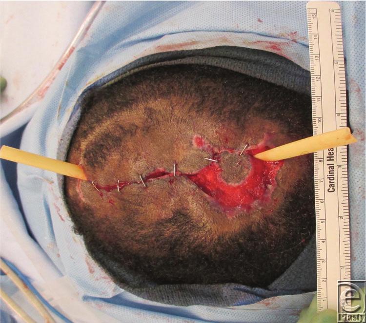 Figure 3. Initially, the patient s scalp was shaved to expose the entire lesion (Fig 1) for thorough irrigation, debridement, and introduction of wet to dry dressings.