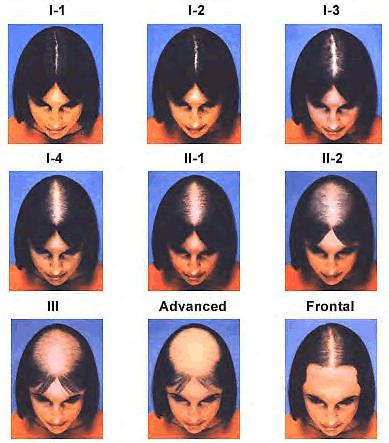 men in both preventing hair loss and triggering regrowth, and it may work for some women, although women must not take it if they are pregnant and must not get pregnant while on the drug because of