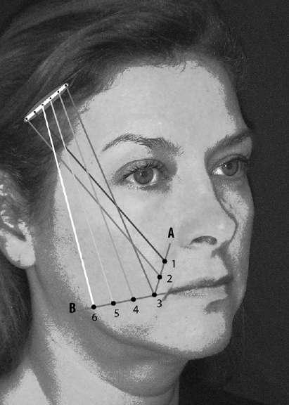 Silhouette Sutures for Treatment of Facial Aging 483 Exit point number 6: located 1.0 cm lateral to point number five, on the jowl line. 2.