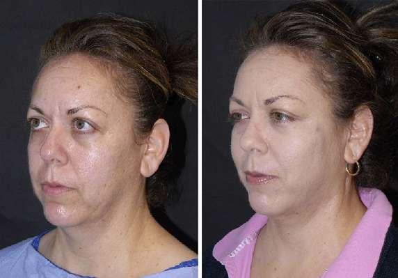 jowling. Liposuction was applied to the jowls and two silhouette sutures were used on each side of the neck.