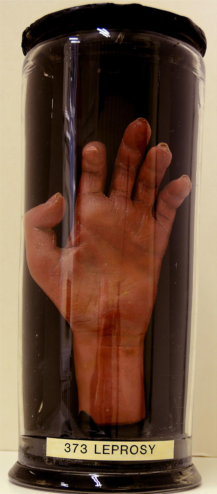 9 Fig. 5: Joseph Towne, Hand showing leprosy from a clerk recently returned from Trinidad, 1859. No. 373, Gordon Museum, King s College London.