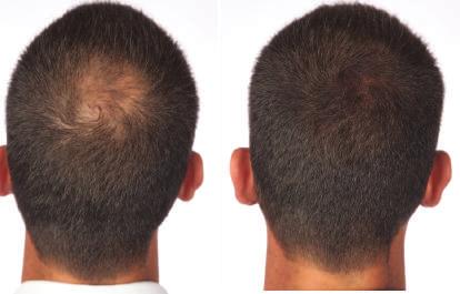 Camouflage Thinning Areas QUICK FIX FOR THICKER LOOKING HAIR Hair fibers are an excellent all natural way of improving the appearance of thinning or balding hair.