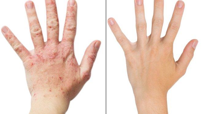 Effect of topical steroid on the skin