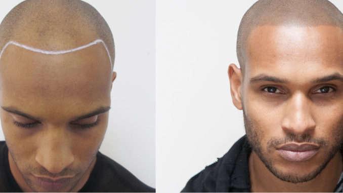 SCALP MICROPIGMENTATION Scalp micropigmentation (SMP) is a process that uses microneedles to tattoo pigment into the scalp.