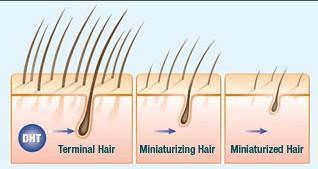 HAIR LOSS IN MEN MPB (male pattern baldness) is a dreaded acronym for many men that is loosing hair.