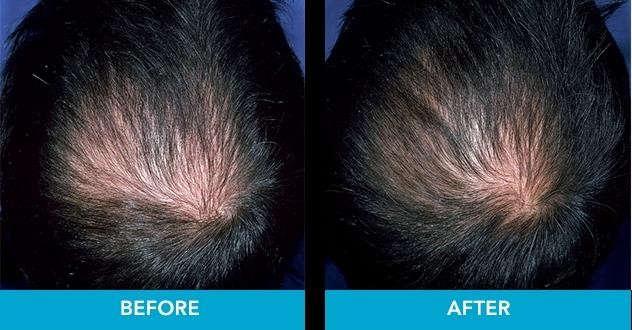 Minoxidil stimulates your hair follicles to grow anywhere you apply it. It works by widening blood vessels, allowing more oxygen, nutrients, and blood to the follicle.