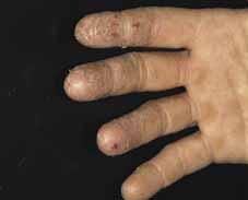 There are two main types of dermatitis: > irritant contact dermatitis, which is the most common, and > allergic contact dermatitis.