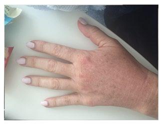 FRAXEL LASER LEFT HAND - 1 DAY AFTER FRAXEL LASER TREATED WITH NEOGENESIS RIGHT HAND - 1 DAY AFTER FRAXEL LASER TREATED WITH ANOTHER LEADING PRODUCT I