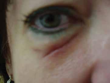 Figure 4. An eyelid ulcer caused by dermal injections. Collagenase is not for beginners, as it can cause ulcers if inadvertently injected into the dermis.