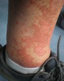 The red skin on my upper body lightened in colour, the rash and the itching reduced slightly, but the shedding continued