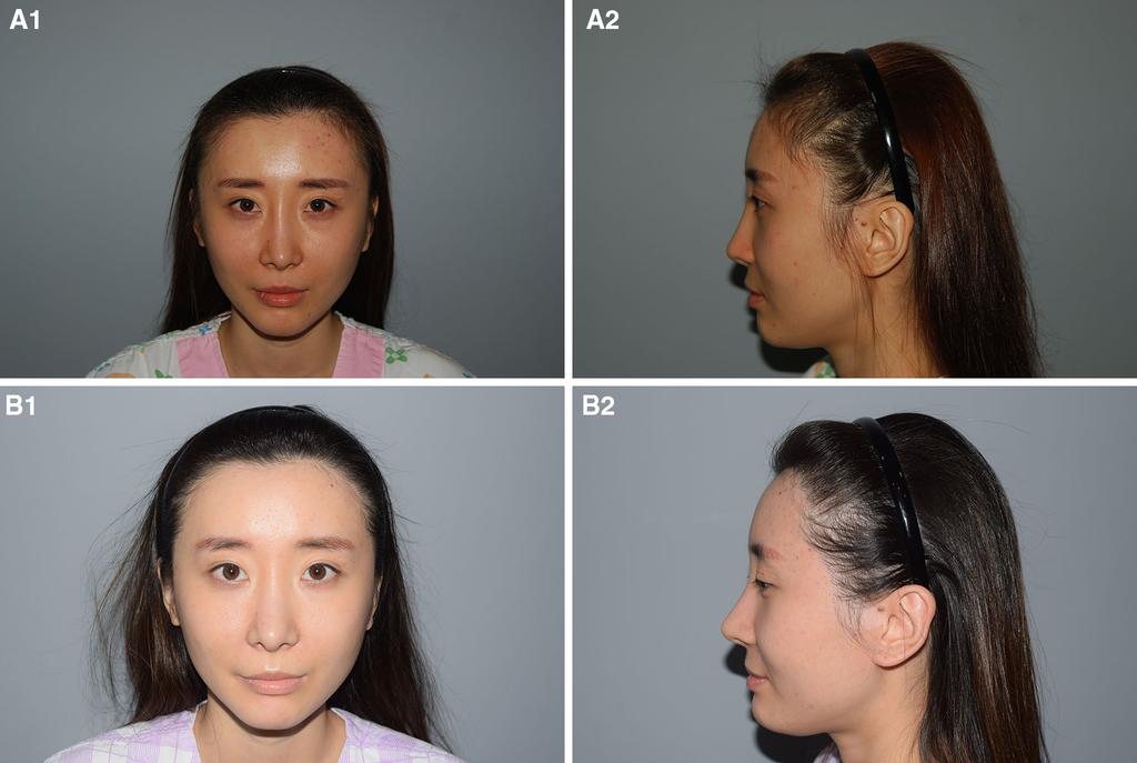 Aesth Plast Surg (2016) 40:921 925 923 Fig. 3 A 27-year-old woman with a CSE-like appearance due to a wide infratemple area.