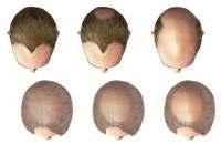 In these cases, the hair loss is not immediately obvious.