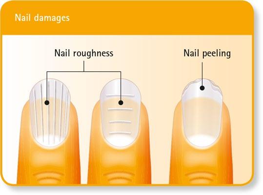 Brittle nail syndrome Brittle nail syndrome is a very common problem characterized by the increased fragility of the nail plate, exhibiting nail roughness, raggedness and peeling.