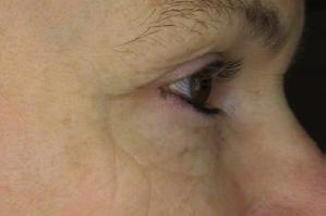Anti-Wrinkle Effect on Crow s Feet after 16 Days of Treatment with PhytoCellTec Alp Rose «cell premium» Research 4.