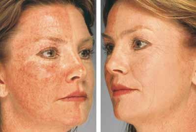 post procedure before and after A marketing study using a split face test to evaluate the