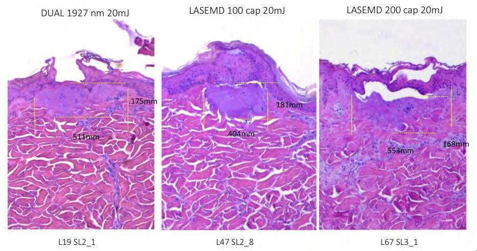 LaseMD Non-Ablative 1927 nm Fractional Thulium Laser Treatments