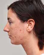 ÉMINENCE ACNE ADVANCED TREATMENT SYSTEM Treats Advanced Acne in 28 Days * The Acne Advanced Treatment