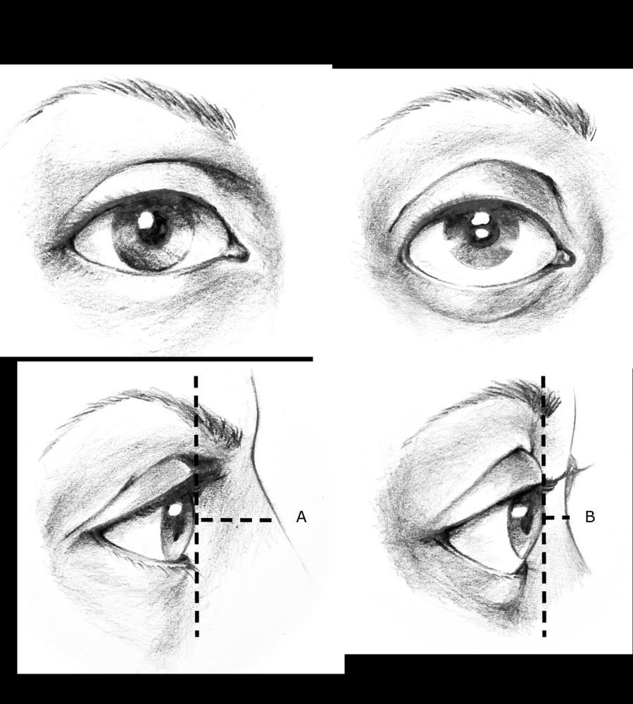 FIG 8 Anterior (Forward) Projection of the Eyes NOTE - A shows an eye with minimal prominence (projection forward from the