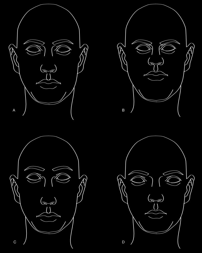 FIG 3 Examples of Alterations to the Positions among Facial Components and the Effect those Positions Have on the Overall Face/Head Composition NOTE A - This face shows the proportions as they are