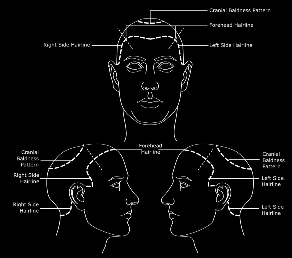 FIG 4 Hairline/Baldness Pattern Facial Image