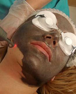 The Hollywood Peel is said to stimulate collagen production, combats acne and evens out skin tone.