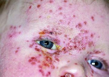 If eczema herpeticum involves the skin around the eyes, the person should be treated with systemic aciclovir and referred for same-day ophthalmological and dermatological advice