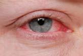 Contra-action An unfavourable reaction that may occur either during or after the treatment, eg skin swelling, excessive erythema.