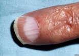 and swelling Diabetes Terry s Paronychia wrinkles around the nails, abnormal shine,