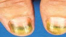 the Surface of the Leukonychia Dents appear on the nail surface Psoriasis or eczema