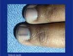 psoriasis or a severe fungal nail infection, jaundice, tuberculosis, sinusitis,